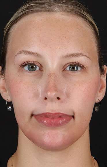 Fillers Before & After Patient #2030