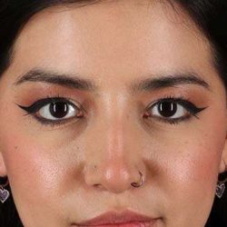 Fillers Before & After Patient #2041