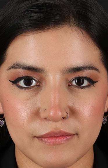 Fillers Before & After Patient #2041