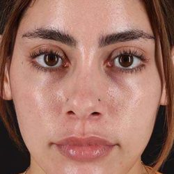 Fillers Before & After Patient #2052