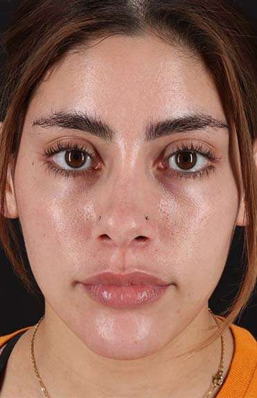 Fillers Before & After Patient #2052