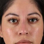 Fillers Before & After Patient #2063