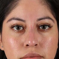 Fillers Before & After Patient #2063