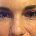 Fillers Before & After Patient #2066