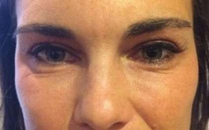 Fillers Before & After Patient #2066