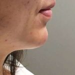 Fillers Before & After Patient #2069