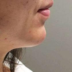 Fillers Before & After Patient #2069