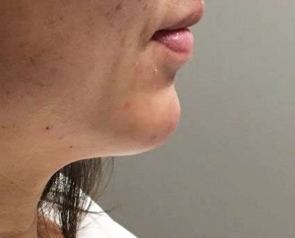 Fillers Before & After Patient #2069