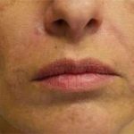 Fillers Before & After Patient #2072