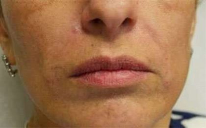 Fillers Before & After Patient #2072
