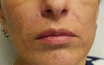 Fillers Before & After Patient #2072