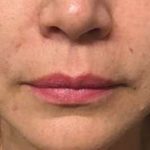 Fillers Before & After Patient #2075