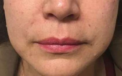 Fillers Before & After Patient #2075