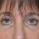 Fillers Before & After Patient #2078
