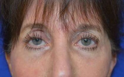 Fillers Before & After Patient #2078