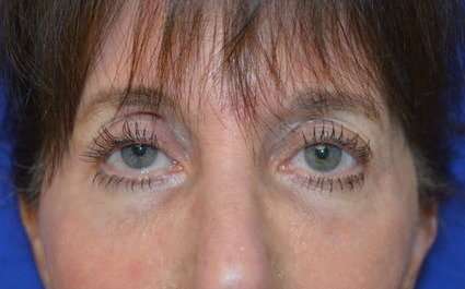 Fillers Before & After Patient #2078