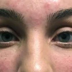 Fillers Before & After Patient #2081
