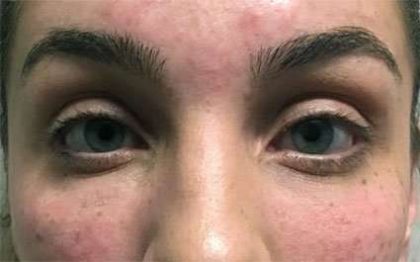 Fillers Before & After Patient #2081