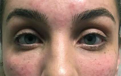 Fillers Before & After Patient #2081