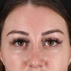 Browlift Before & After Patient #1330