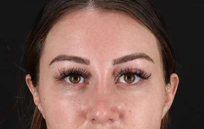 Browlift Before & After Patient #1330