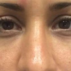 Fillers Before & After Patient #2084