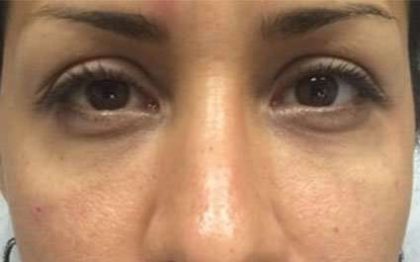 Fillers Before & After Patient #2084
