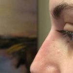 Fillers Before & After Patient #2087