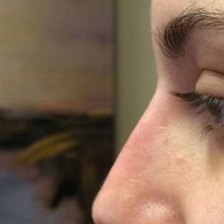 Fillers Before & After Patient #2087