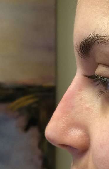 Fillers Before & After Patient #2087
