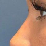 Fillers Before & After Patient #2090