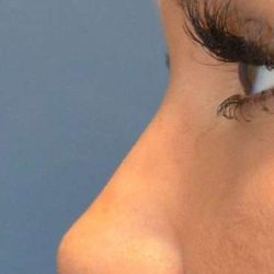 Fillers Before & After Patient #2090