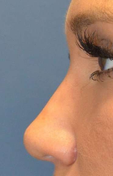 Fillers Before & After Patient #2090