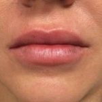 Fillers Before & After Patient #2096