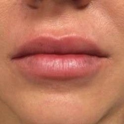Fillers Before & After Patient #2096
