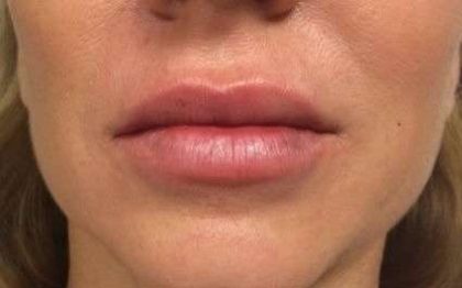 Fillers Before & After Patient #2096