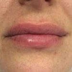 Fillers Before & After Patient #2099