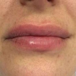 Fillers Before & After Patient #2099