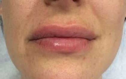 Fillers Before & After Patient #2099