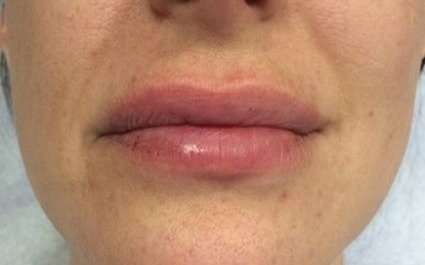 Fillers Before & After Patient #2099