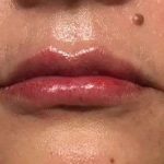 Fillers Before & After Patient #2102