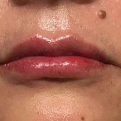 Fillers Before & After Patient #2102