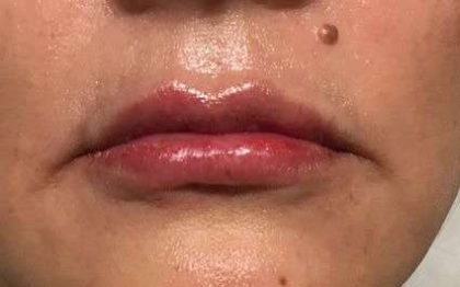 Fillers Before & After Patient #2102