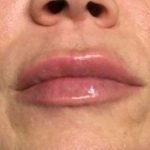 Fillers Before & After Patient #2105