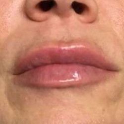 Fillers Before & After Patient #2105