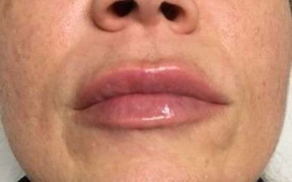Fillers Before & After Patient #2105