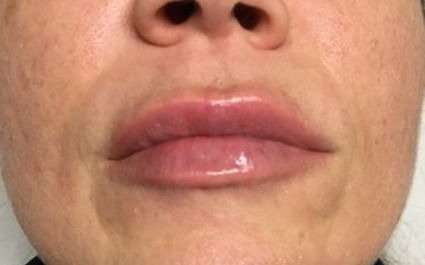 Fillers Before & After Patient #2105