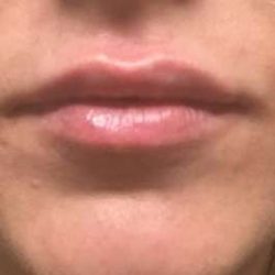 Fillers Before & After Patient #2108