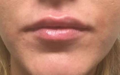 Fillers Before & After Patient #2108