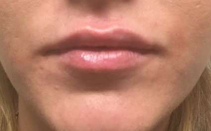 Fillers Before & After Patient #2108
